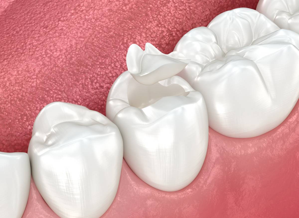 featured image for blog on how often should you replace dental sealants
